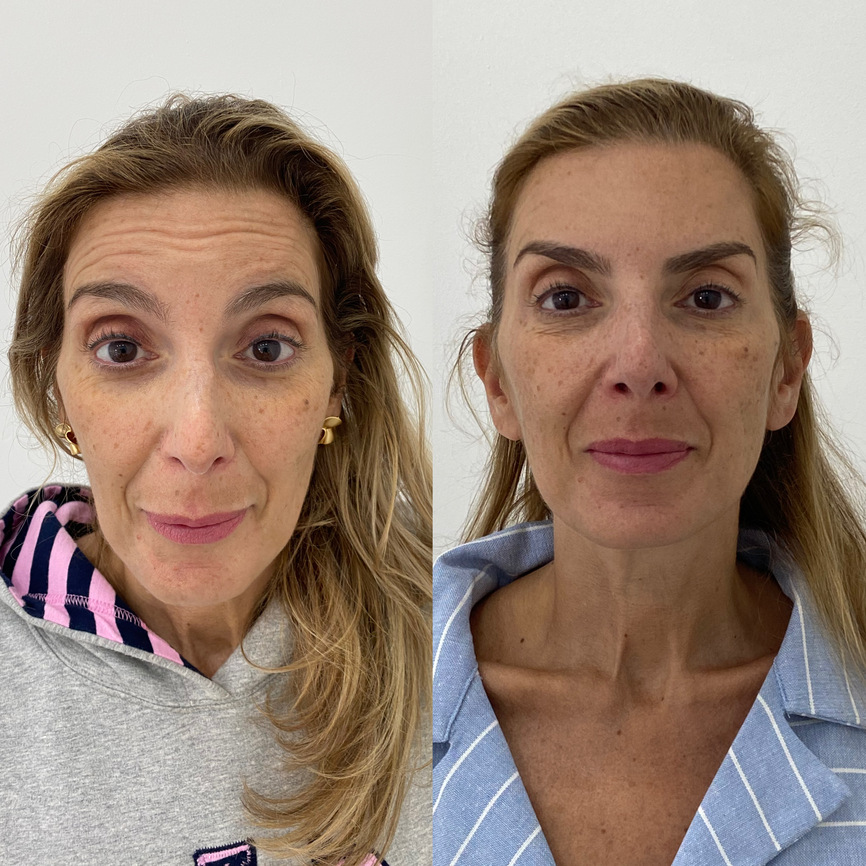 Toxina Botulínica